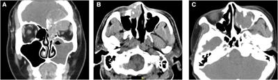 Sinonasal NUT carcinoma: A retrospective case series from a single institution